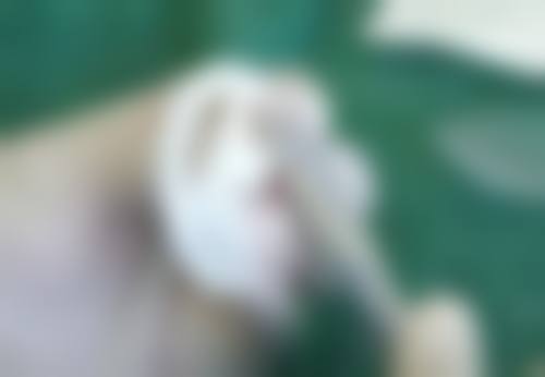 隆鼻假体取出的手术时机怎么选择？