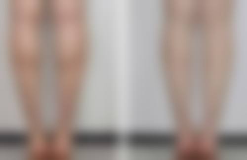 割双眼皮可以吃凤梨吗？适量食用补充维C，利于伤口愈合且一般无不良影响 