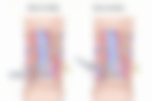 注射类丰太阳穴会发生血管栓塞吗？