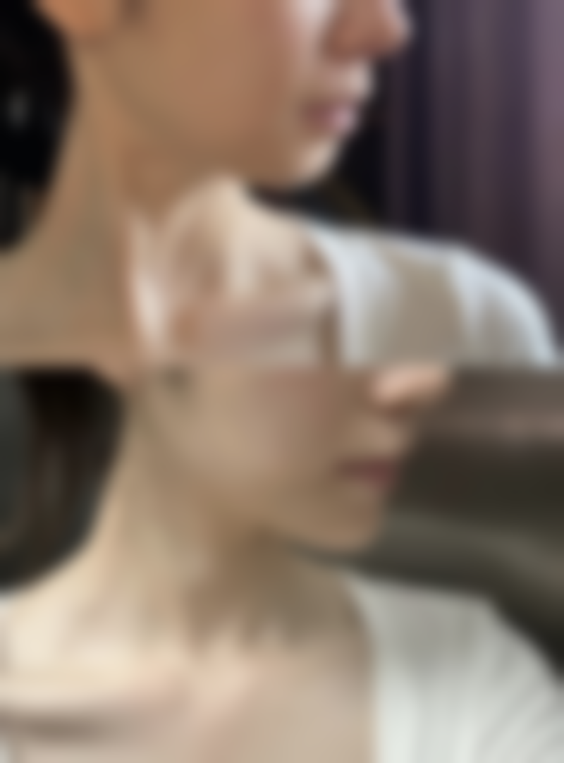 丰太阳穴会有什么后遗症？可能出现感染、血肿、效果不自然等情况你了解吗？ 