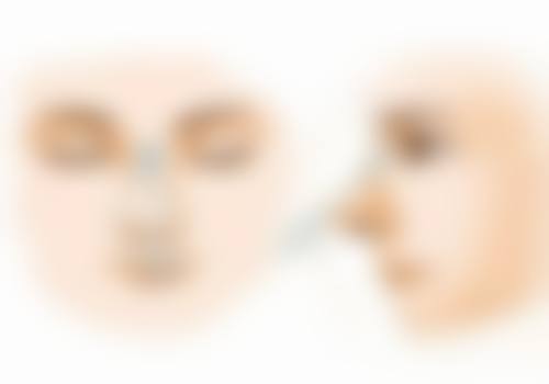 吸脂去眼袋的成效如何？