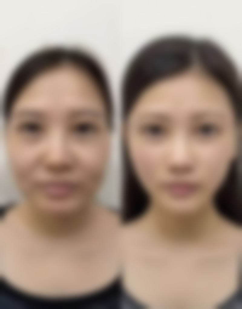 哪些因素会影响下眼袋手术的修复期？