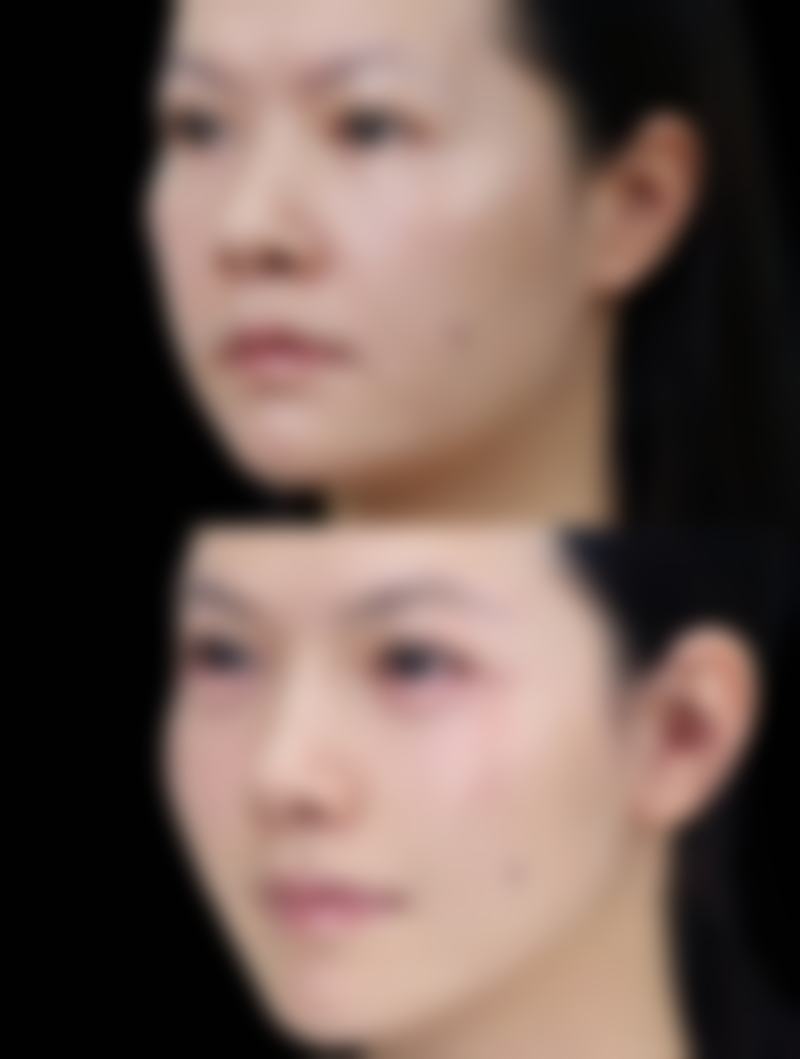 日常有哪些快速改善眼袋的方法？