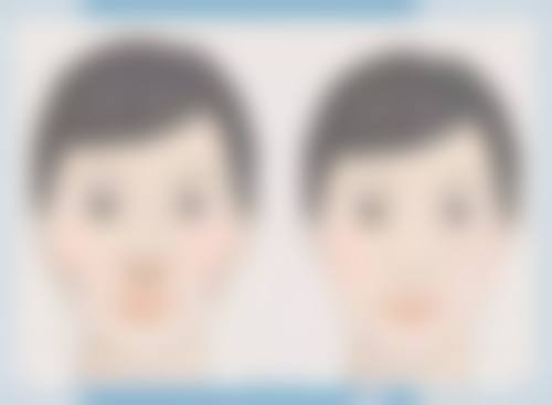 平扇形双眼皮为什么适合长脸呢？