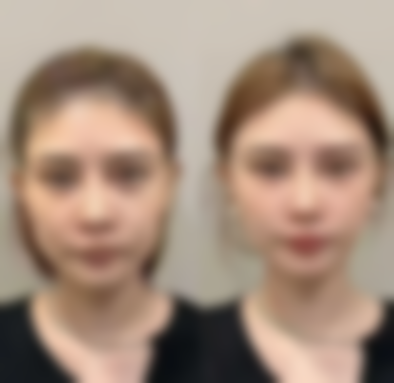 平行型双眼皮对长脸有什么优势呢？