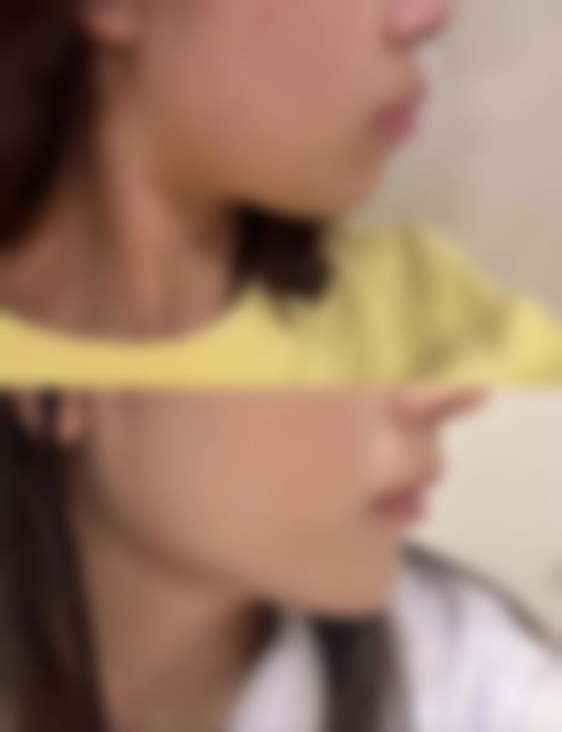 疤痕体质会带来局部不适症状吗？