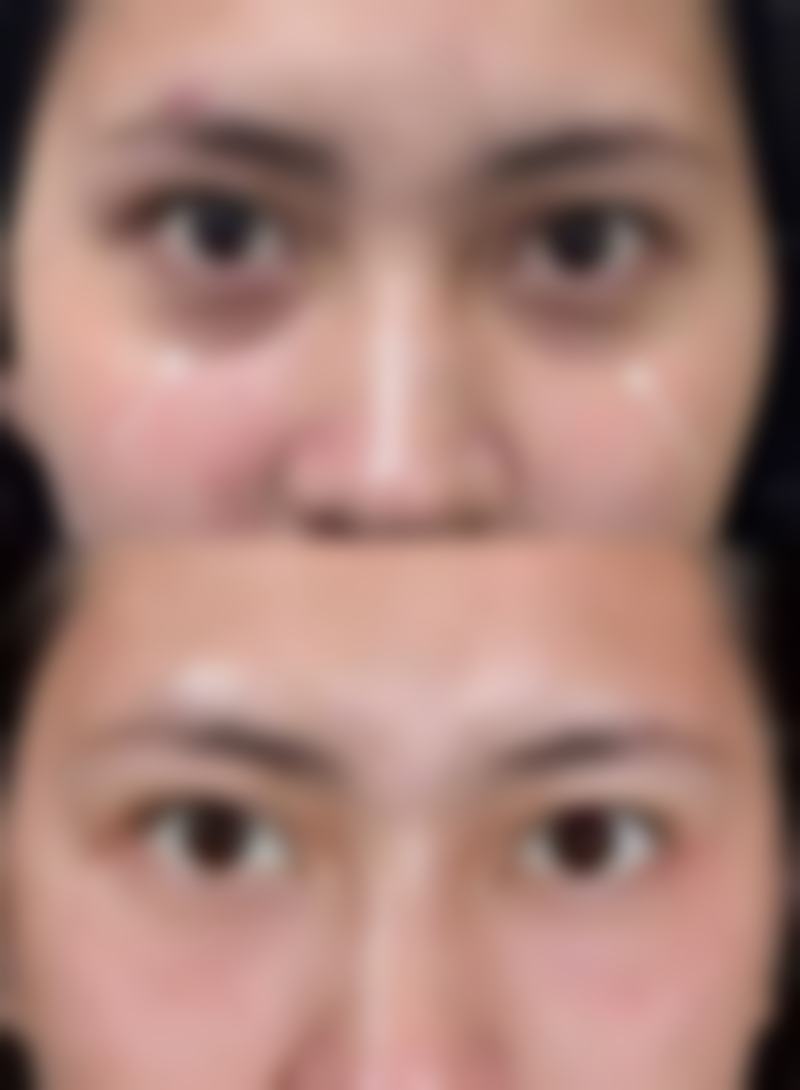 吉安市韩美美容医疗门诊部自体脂肪丰臀优势体现在哪些方面?