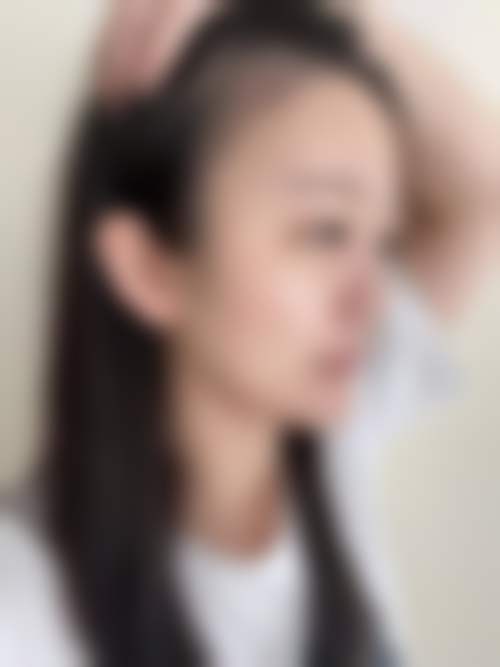 扬州俏华美医疗美容诊所点痣项目适合哪些人？