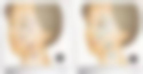 药物治疗能消除大眼袋吗?