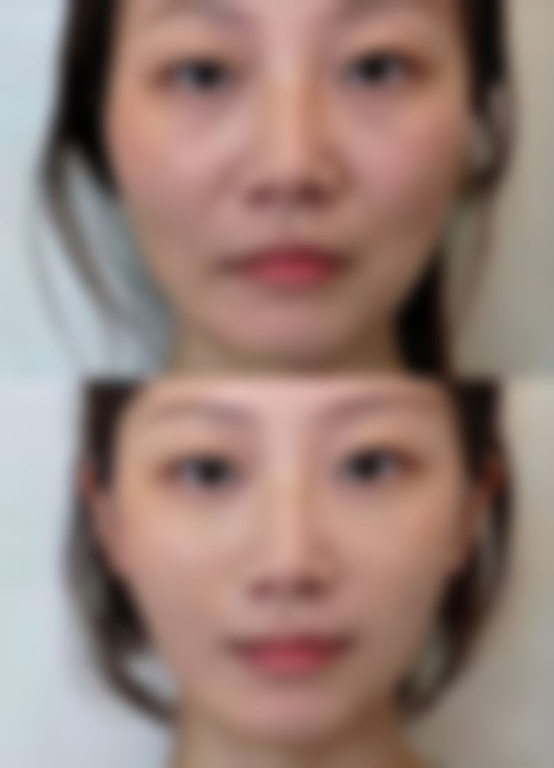 不同隆鼻材料的相关情况如何