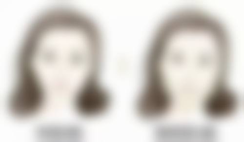 埋线双眼皮能维持多久呢?
