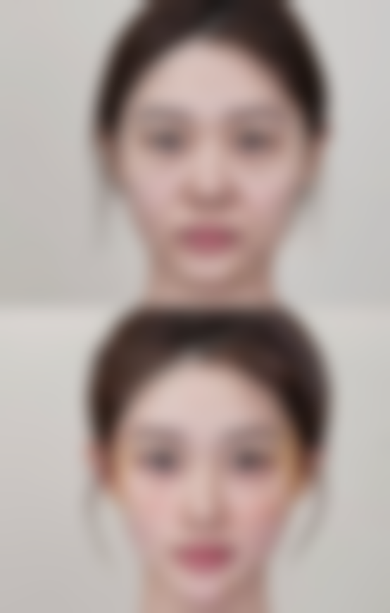 埋线双眼皮术后该怎么护理呢?
