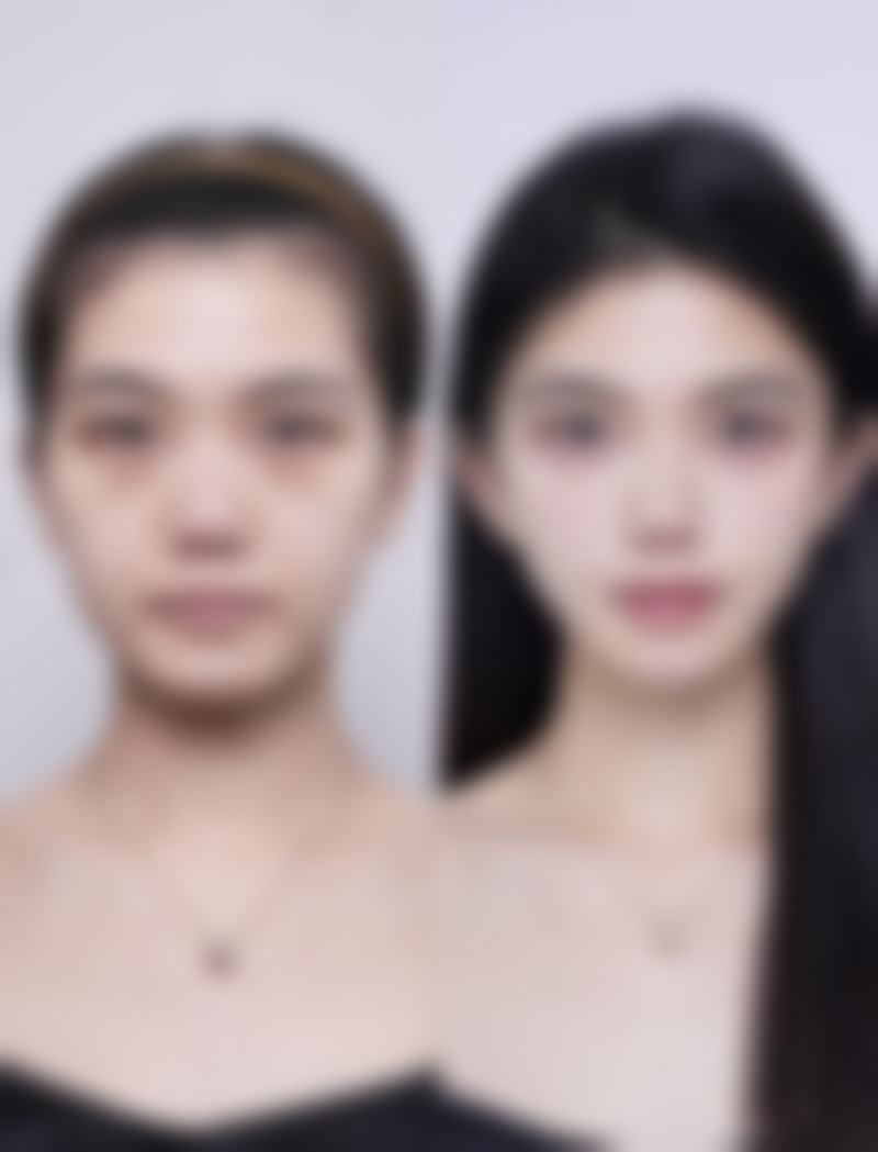 埋线双眼皮哪好啊？它创伤小、恢复快，还能呈现自然灵动的眼部效果你知道吗？ 