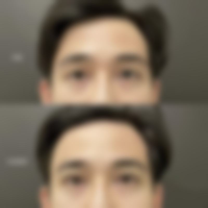 除皱针的成效一般能维持多久呢？