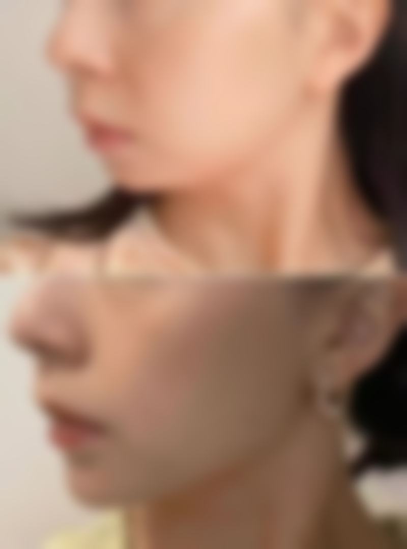 夏天怎么减少出汗和高温暴露对除皱针的影响呢？