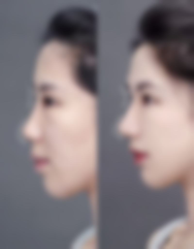 瘦咬肌需要注意什么?