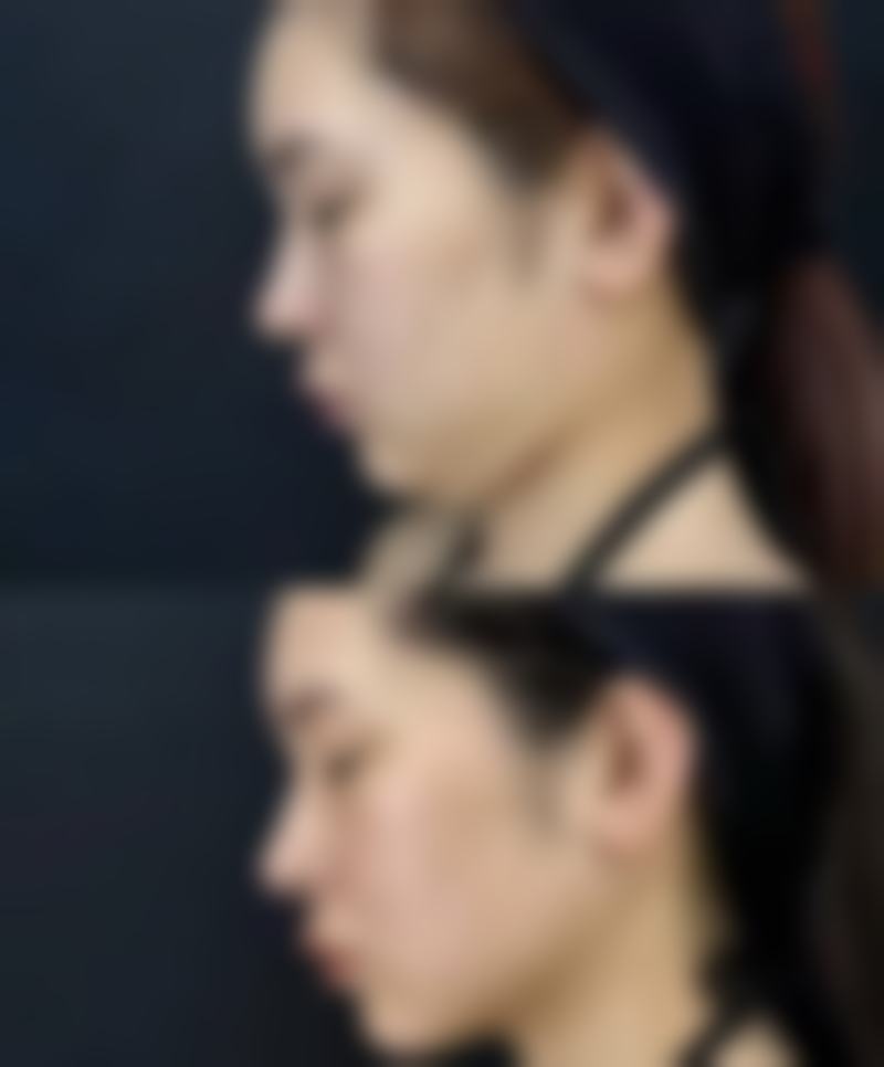 隆鼻的副作用会持续特别久吗？