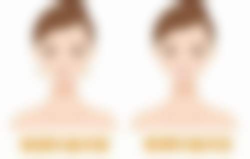 颧骨整形可能会有哪些后遗症?