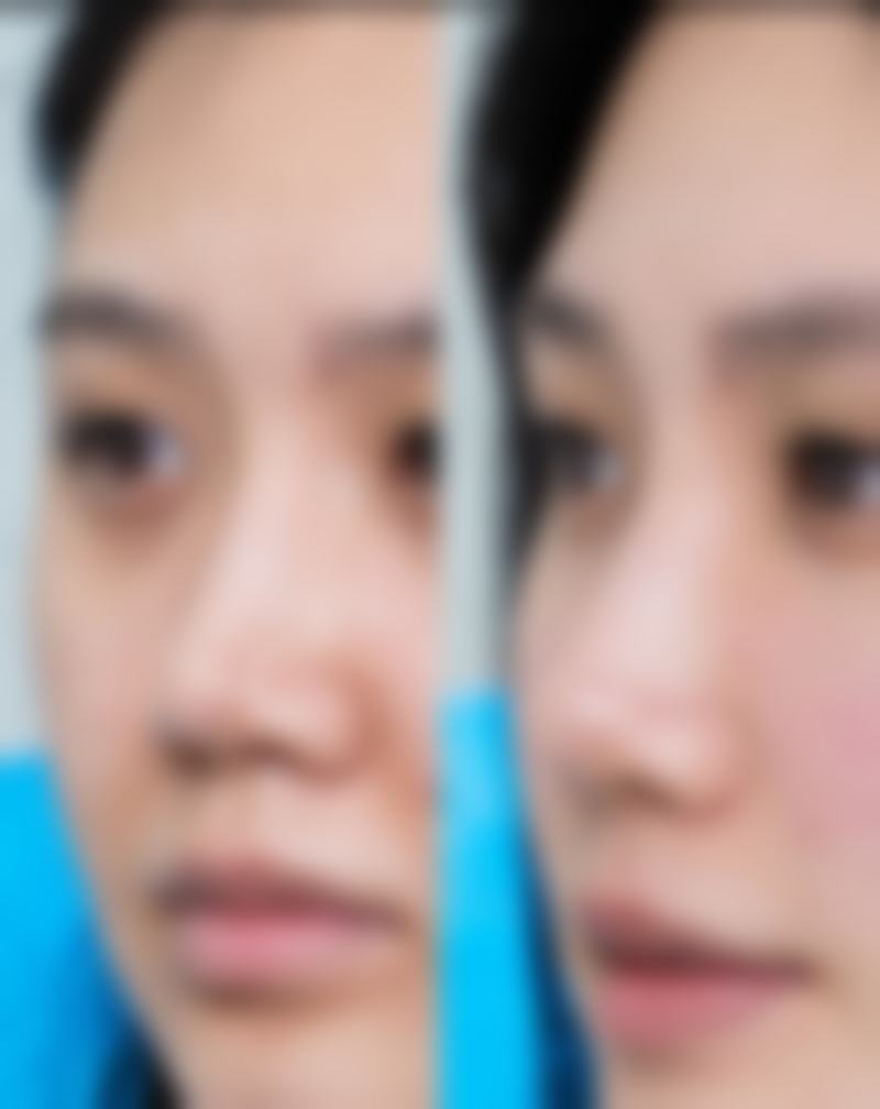 如果颧骨整形后出现面部下垂,有什么改善方式吗?