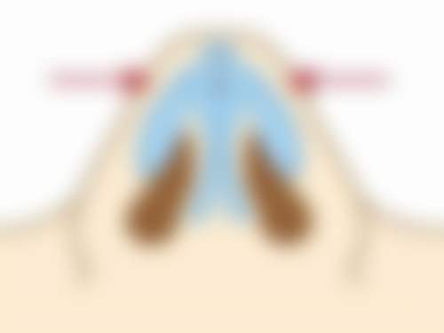 割双眼皮伤到神经有哪些治疗方式?