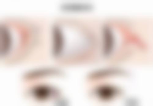 如何预防割双眼皮时伤到神经?