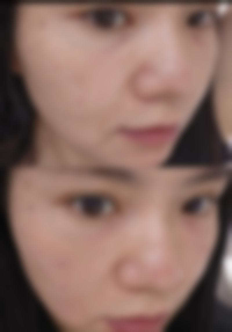 割双眼皮伤到神经后,日常该如何护理?