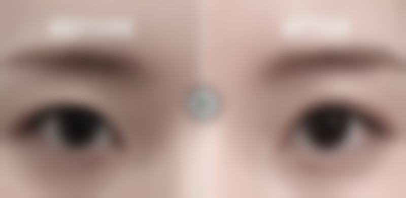 宽双眼皮修复有哪些方法？