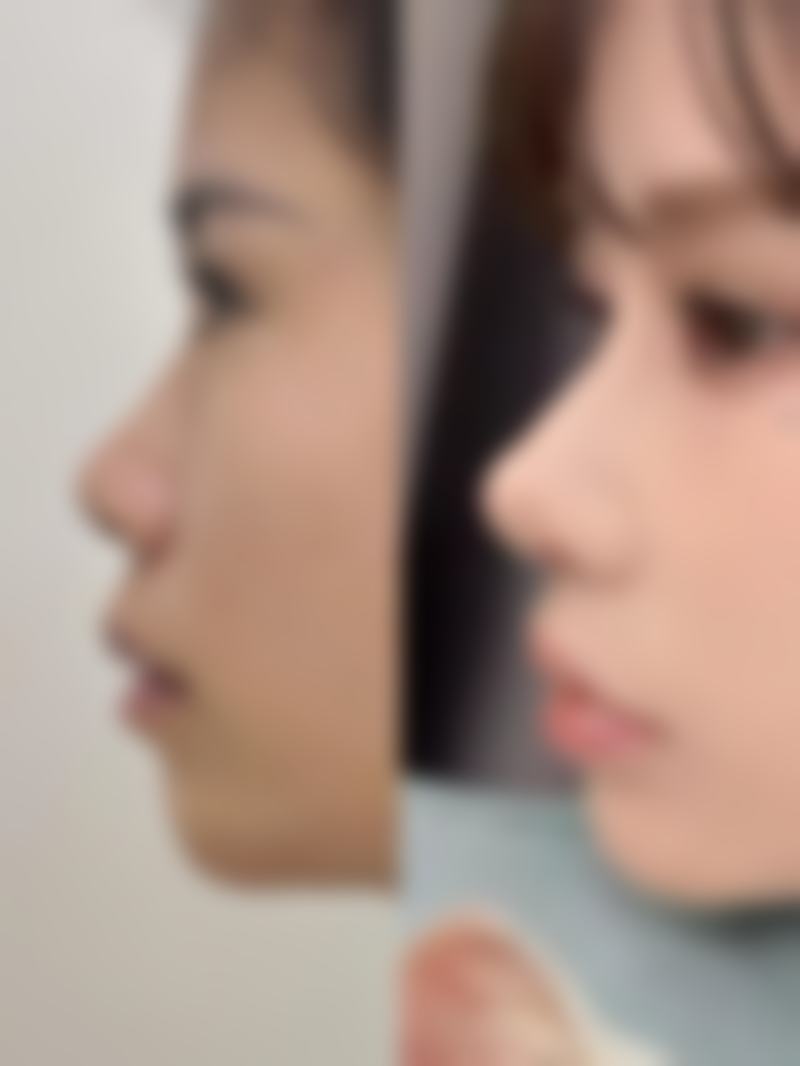 联合中面部处理的外切眼袋手术能改善法令纹吗?