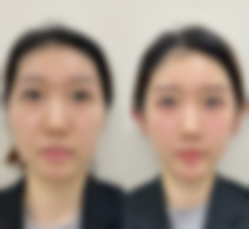 眼部护理与物理疗法能去除长期熬夜的眼袋吗?