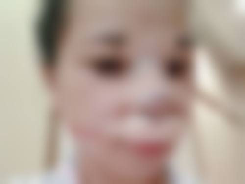 有真实实例能证明大腿抽脂会瘦吗？