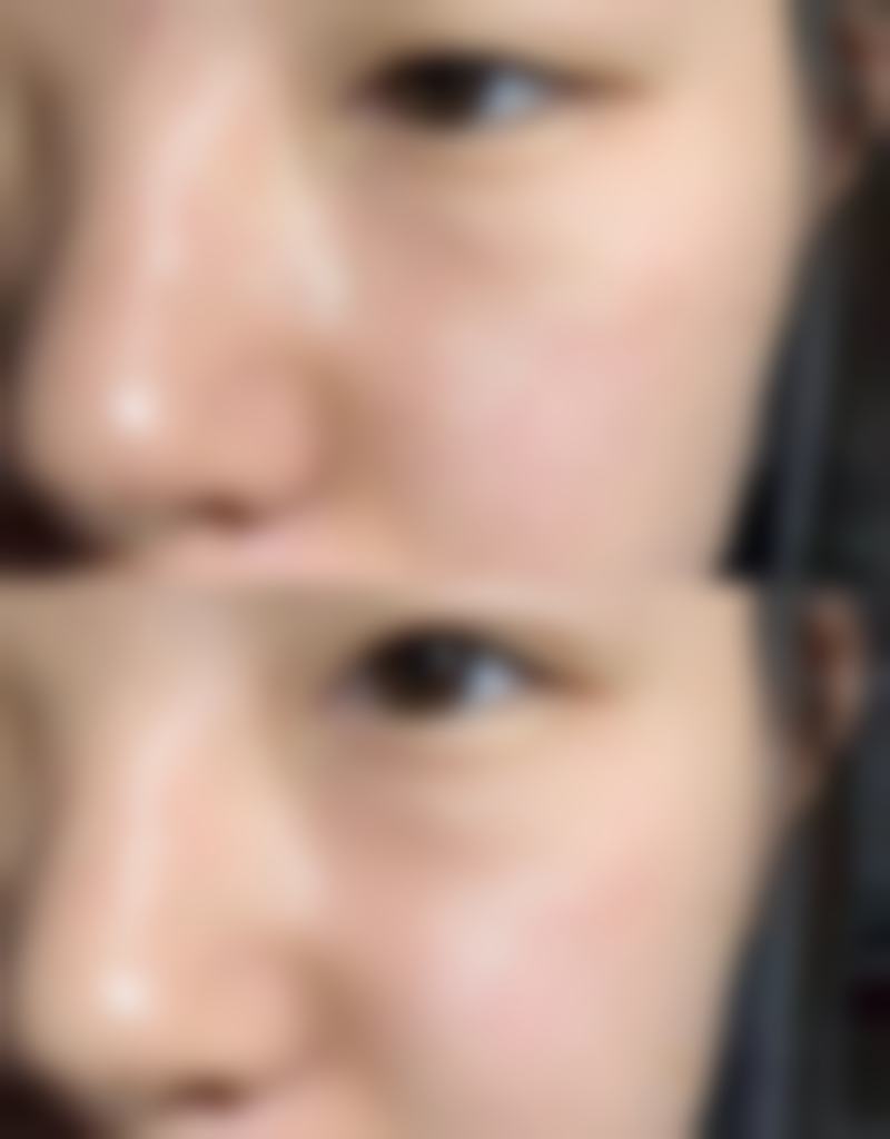 大腿抽脂有什么需要补充说明的吗？