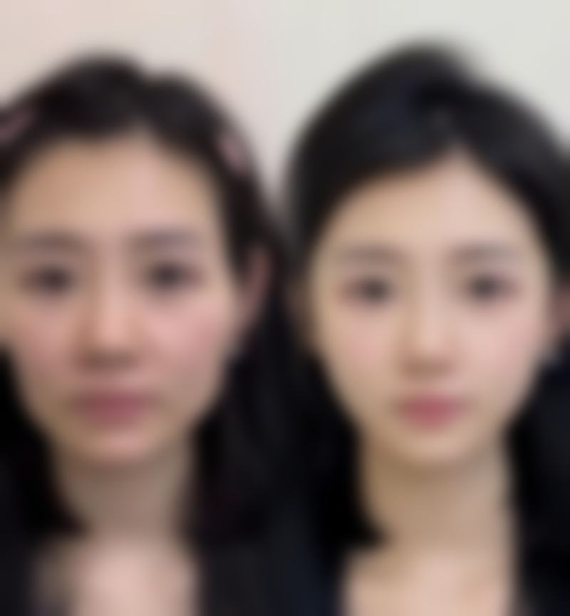韩国LH整形外科咸正旭医生隆鼻技术怎么样?