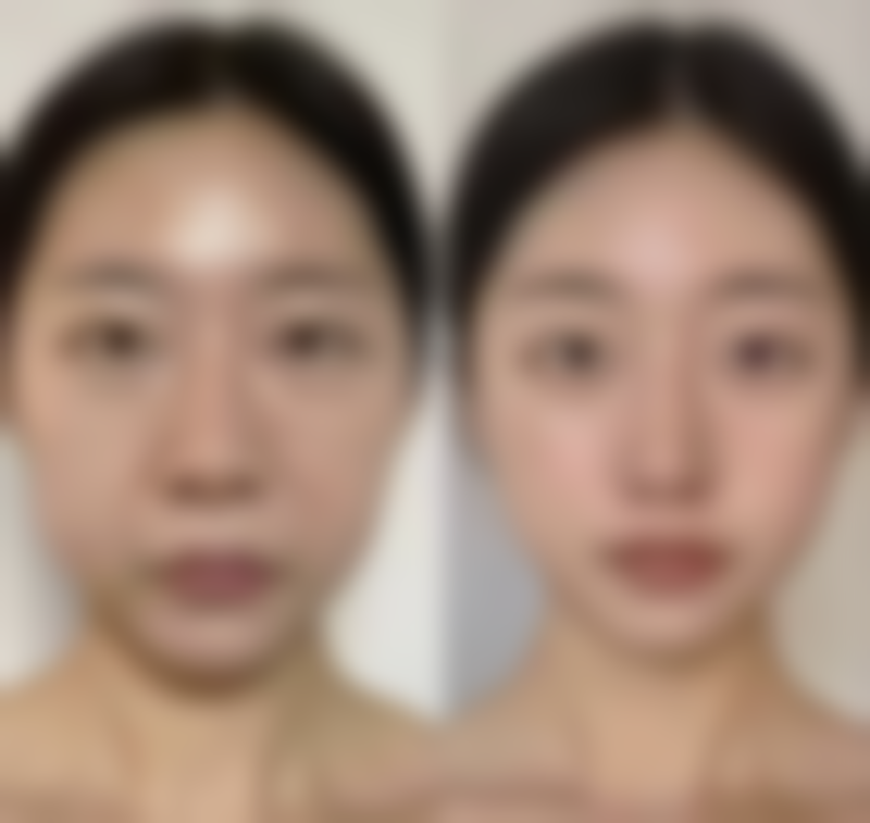 术后3个月内为什么要避免高温环境？