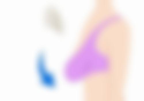 48岁女性隆胸的整体建议是什么?