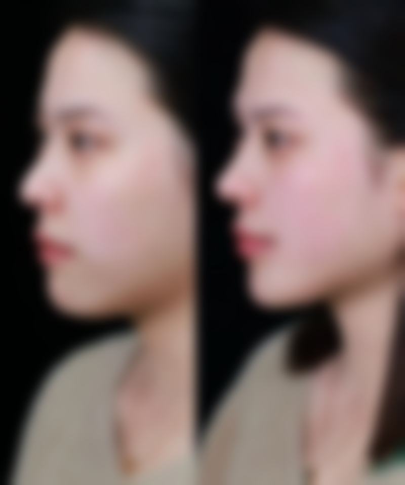江汉油田总医院整形美容外科李仁清医生水动力吸脂瘦大腿技术怎么样?