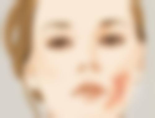 冷冻治疗和放射疗法适用于哪些烧伤疤痕?有什么风险吗?