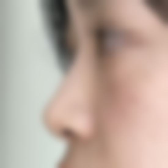 我再也不用担心侧脸了！线雕拯救了我的模糊下颌线