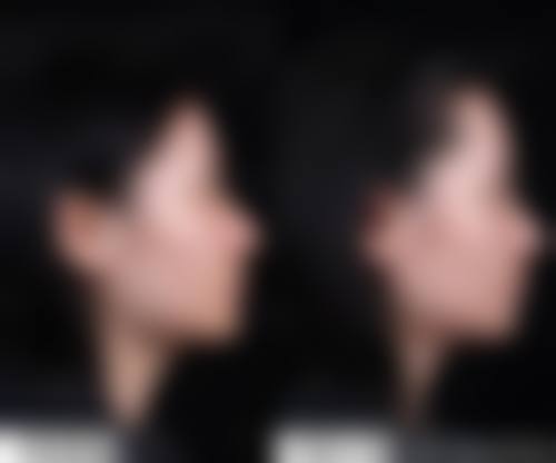 临床实例分享 朱乾丽 上海盛美倾城医疗美容门诊部